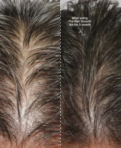 The Hair Growth Kit